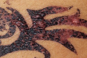 Typical "Black henna" reaction: swelling, itching, blistering, scarring and more.