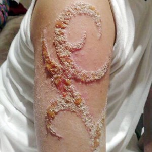 Typical "black henna" reaction
